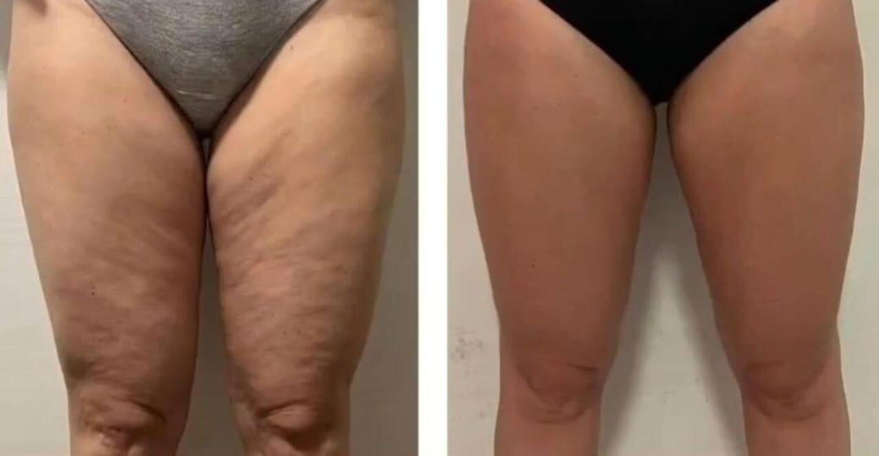 Resultado Pernas — Santoli Clinic Care